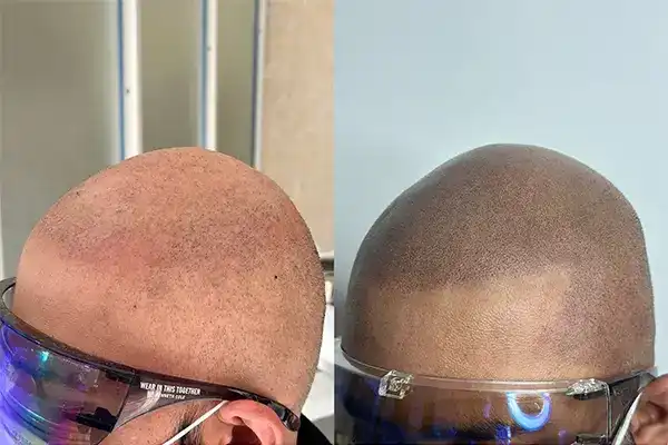 Best SMP in India – Scalpdots Result 1