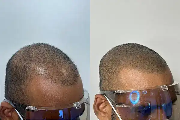 Best SMP in India – Scalpdots Result 2