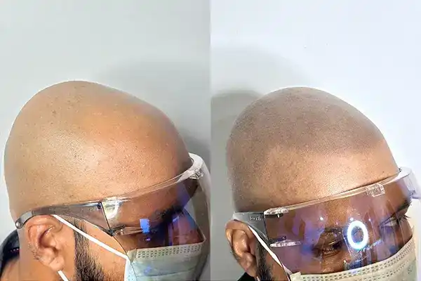 Best SMP in India – Scalpdots Result 5